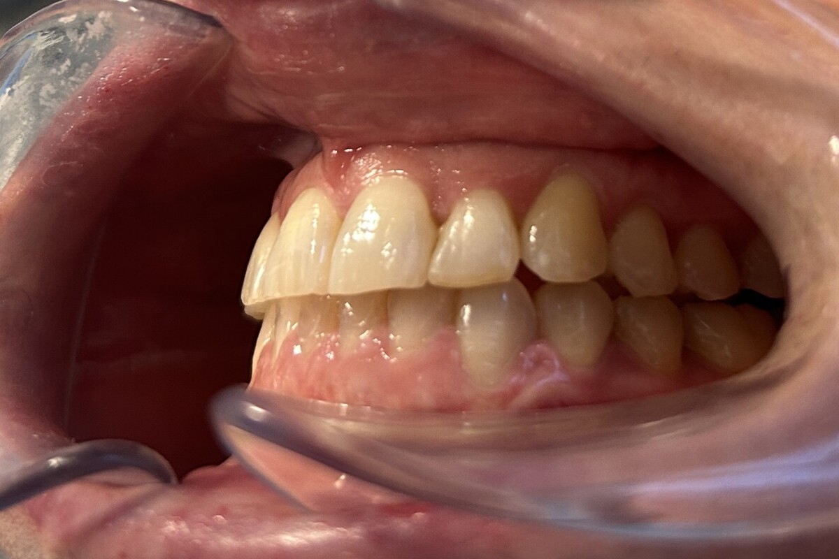 Relleno de labios y surcos peribucales: sonrisa y labios tras el tratamiento