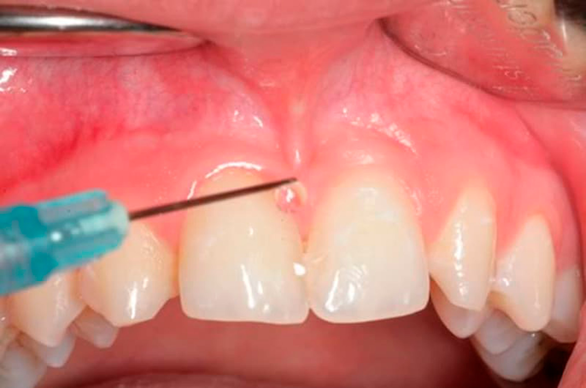 Relleno de labios y surcos peribucales: ácido hialurónico como material de relleno